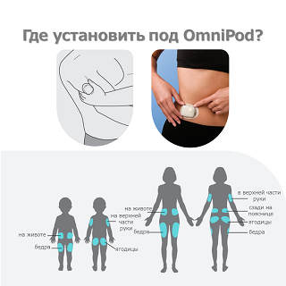 Где установить ПОД Omnipod?